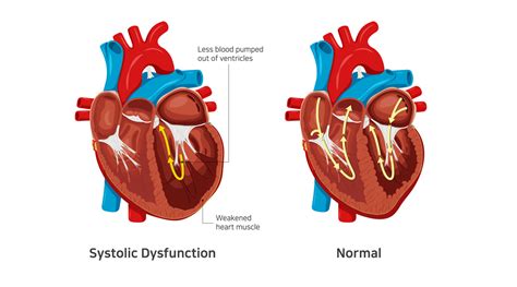 symptoms of systolic heart failure